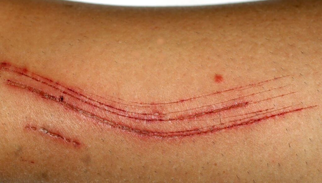 A person displaying a large arm wound indicating a serious injury